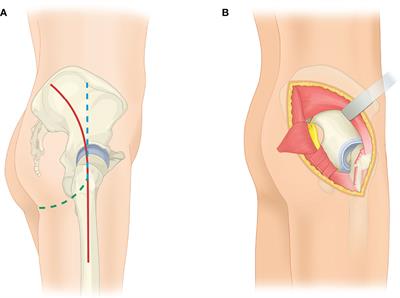 Combined and Modified Gibson and Ilioinguinal Approaches in Type II + III Internal Hemipelvectomy for Periacetabular Tumors